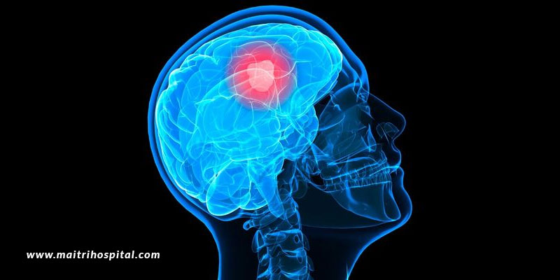 Brain Tumour – Warning Signs